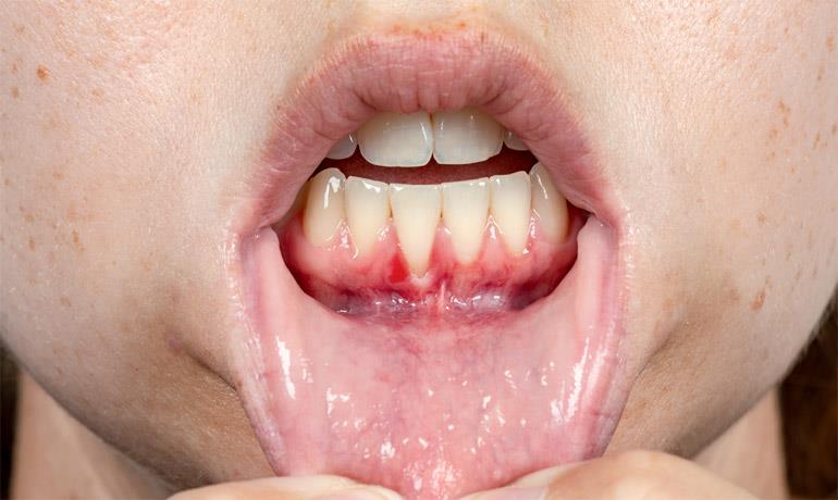 عوارض عفونت دندان و نحوه درمان آن چیست؟